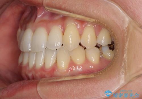 前歯のデコボコ　インビザラインによる矯正治療の治療中