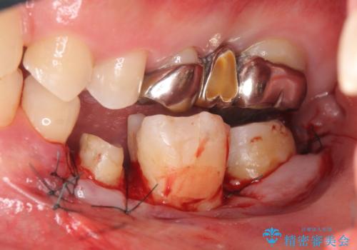オールセラミッククラウン　歯の挺出・歯周外科による歯茎より深い虫歯の治療の治療後