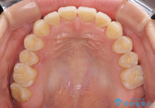 前歯のデコボコ インビザラインによる矯正治療の治療中