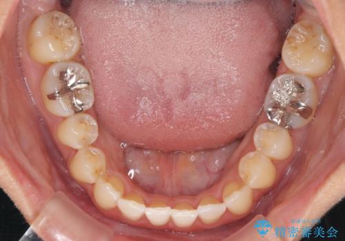 前歯のデコボコ インビザラインによる矯正治療の治療中