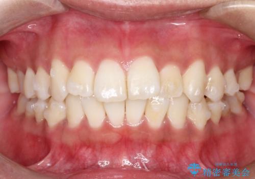 がたがたをインビザラインで整った歯並びへの治療中