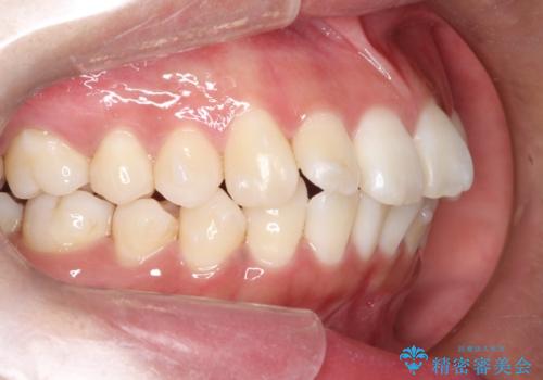 がたがたをインビザラインで整った歯並びへの治療中