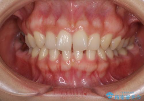 隙間だらけの歯列をきれいに インビザライン矯正とセラミック補綴治療の症例 治療前
