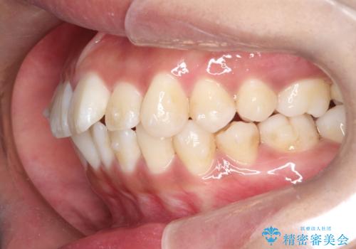 がたがたをインビザラインで整った歯並びへの治療中