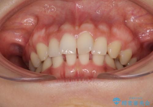 隙間だらけの歯列をきれいに インビザライン矯正とセラミック補綴治療の治療前