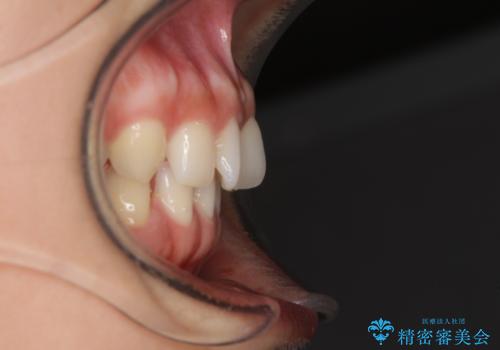 隙間だらけの歯列をきれいに インビザライン矯正とセラミック補綴治療の治療前