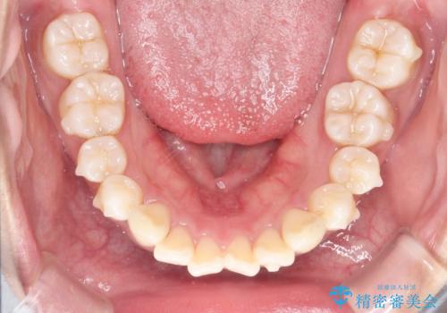 がたがたをインビザラインで整った歯並びへの治療中