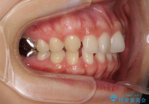 隙間だらけの歯列をきれいに インビザライン矯正とセラミック補綴治療の治療前