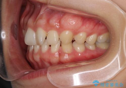 隙間だらけの歯列をきれいに インビザライン矯正とセラミック補綴治療の治療前