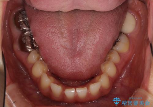 隙間だらけの歯列をきれいに インビザライン矯正とセラミック補綴治療の治療前