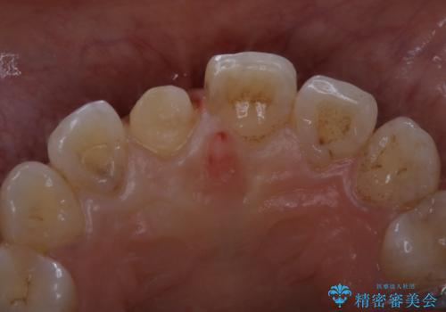 何度も欠けてしまう前歯を被せ物で治療の治療中