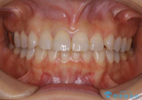 何度も欠けてしまう前歯を被せ物で治療の治療後