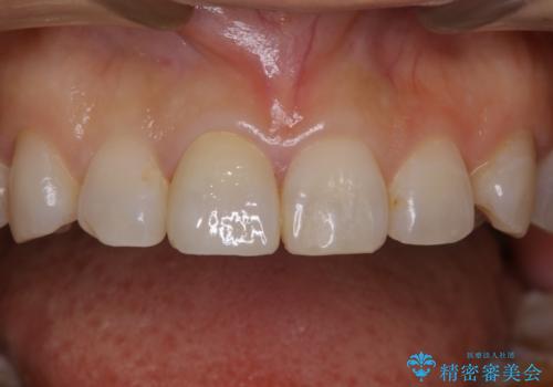 何度も欠けてしまう前歯を被せ物で治療の症例 治療後