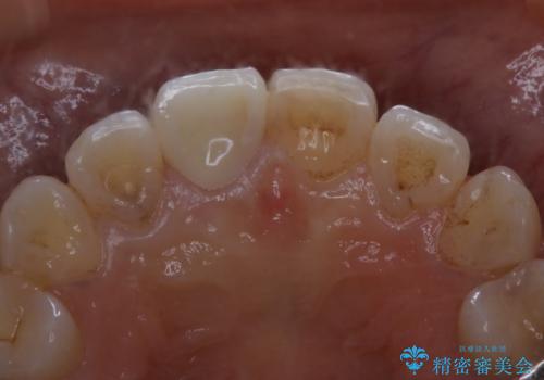 何度も欠けてしまう前歯を被せ物で治療の治療後