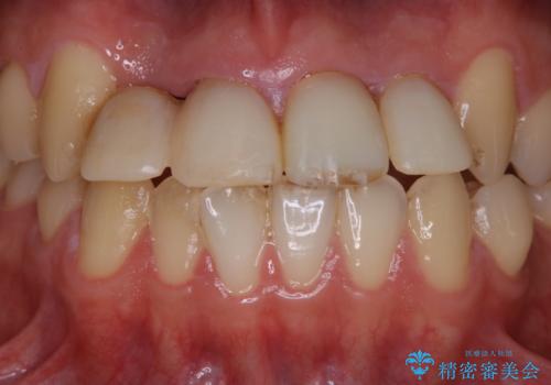 インプラント治療途中にPMTCの治療前