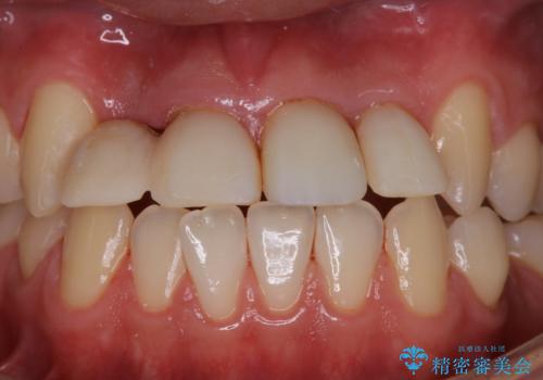 インプラント治療途中にPMTCの治療後