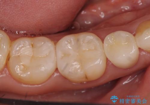 オールセラミッククラウン セラミックインレー しみる奥歯の治療の治療後