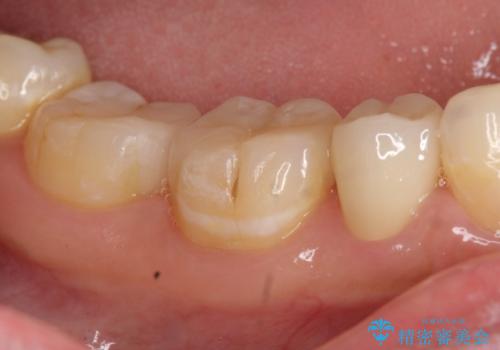 オールセラミッククラウン セラミックインレー しみる奥歯の治療の治療後