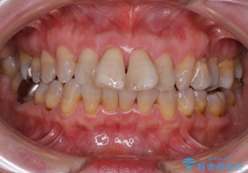 閉じにくい口元を改善したい　ワイヤー装置での抜歯矯正の症例 治療前