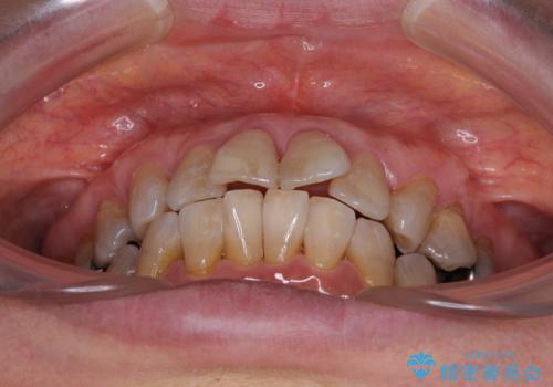 閉じにくい口元を改善したい　ワイヤー装置での抜歯矯正の治療前