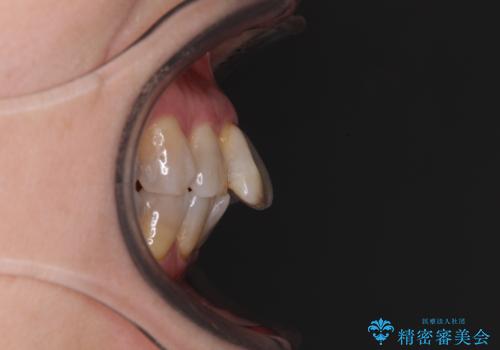 閉じにくい口元を改善したい ワイヤー装置での抜歯矯正の治療前