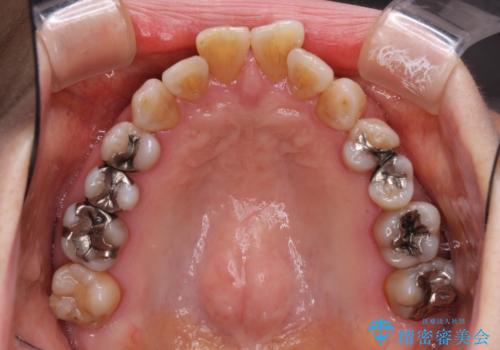 閉じにくい口元を改善したい ワイヤー装置での抜歯矯正の治療前