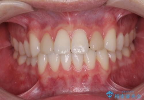 ラミネートの前歯をオールセラミッククラウンで自然にの治療前