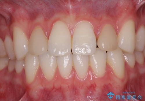 ラミネートの前歯をオールセラミッククラウンで自然にの治療前
