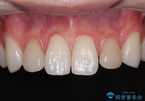 ラミネートの前歯をオールセラミッククラウンで自然にの治療前