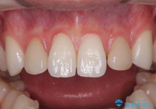 ラミネートの前歯をオールセラミッククラウンで自然にの治療前