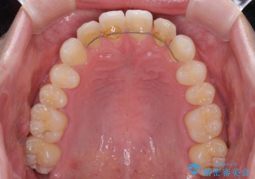 ラミネートの前歯をオールセラミッククラウンで自然にの治療前