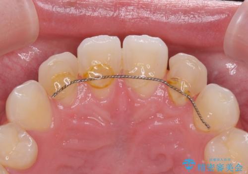 ラミネートの前歯をオールセラミッククラウンで自然にの治療前