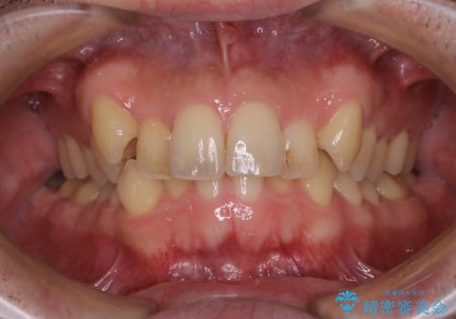 タバコのヤニをPMTCできれいにの治療前