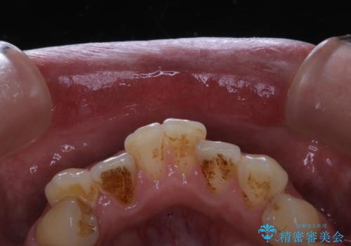 タバコのヤニをPMTCできれいにの治療前