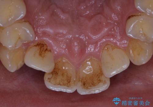 タバコのヤニをPMTCできれいにの治療前