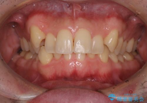 タバコのヤニをPMTCできれいにの治療後