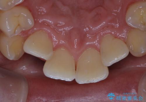 タバコのヤニをPMTCできれいにの治療後