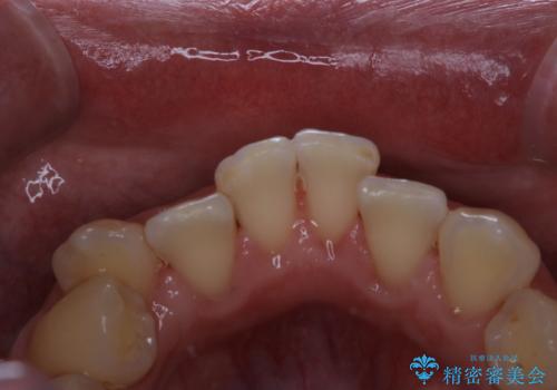 タバコのヤニをPMTCできれいにの治療後