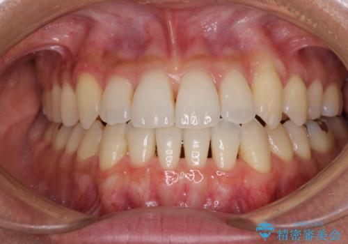 前歯のデコボコ　インビザラインによる矯正治療
