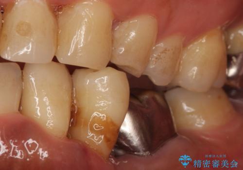 インプラント 左下奥歯の咬み合わせの改善の治療前