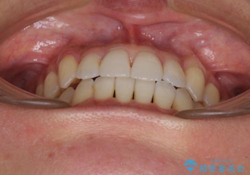 前歯のデコボコ　インビザラインによる矯正治療の治療後