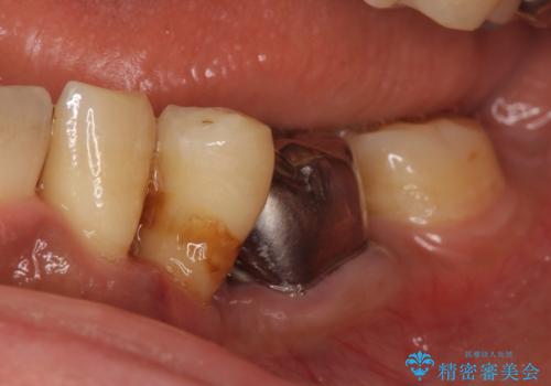 インプラント 左下奥歯の咬み合わせの改善の治療前