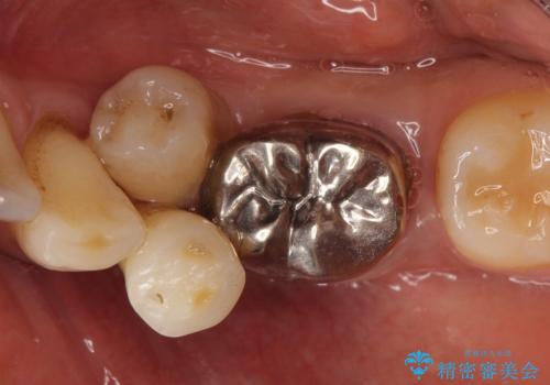 インプラント　左下奥歯の咬み合わせの改善