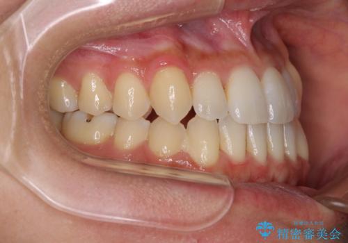 前歯のデコボコ インビザラインによる矯正治療の治療後