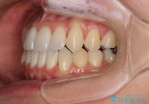 前歯のデコボコ　インビザラインによる矯正治療の治療後