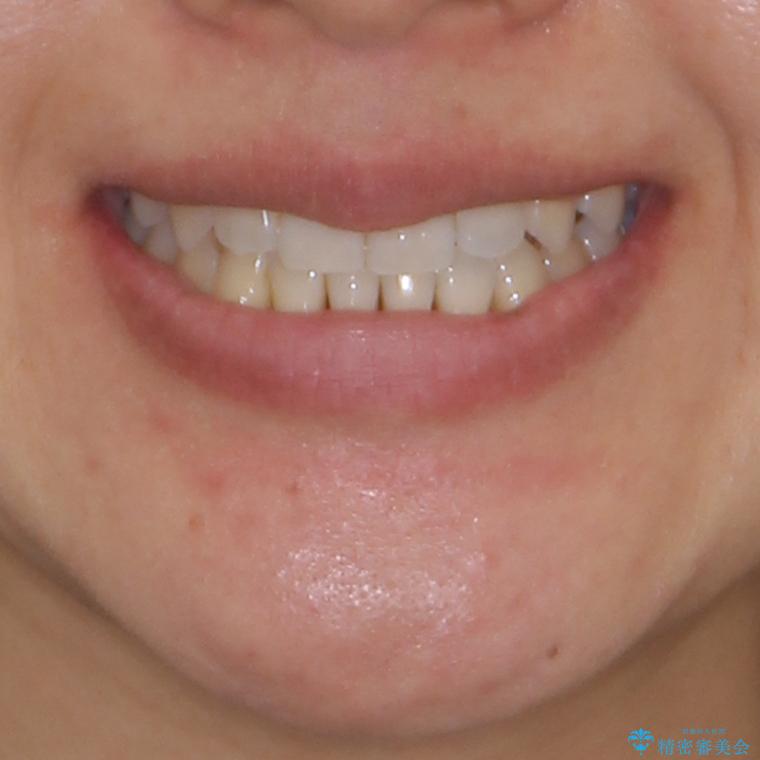前歯のデコボコ　インビザラインによる矯正治療の治療後（顔貌）