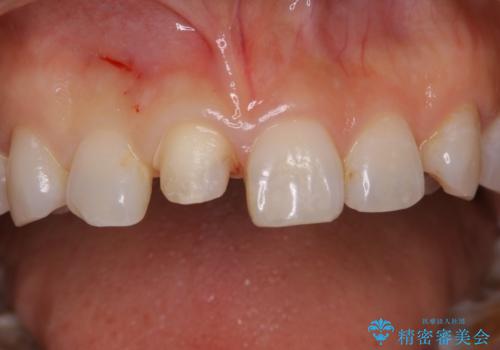 何度も欠けてしまう前歯を被せ物で治療の治療中