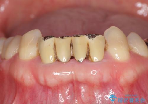 前歯の保険のブリッジ 欠けてしまったのをやり直したい