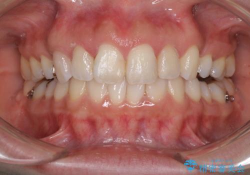 前歯の突出を軽減 インビザラインによる抜歯矯正の治療中