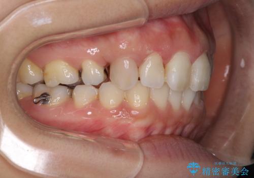 前歯の突出を軽減 インビザラインによる抜歯矯正の治療中